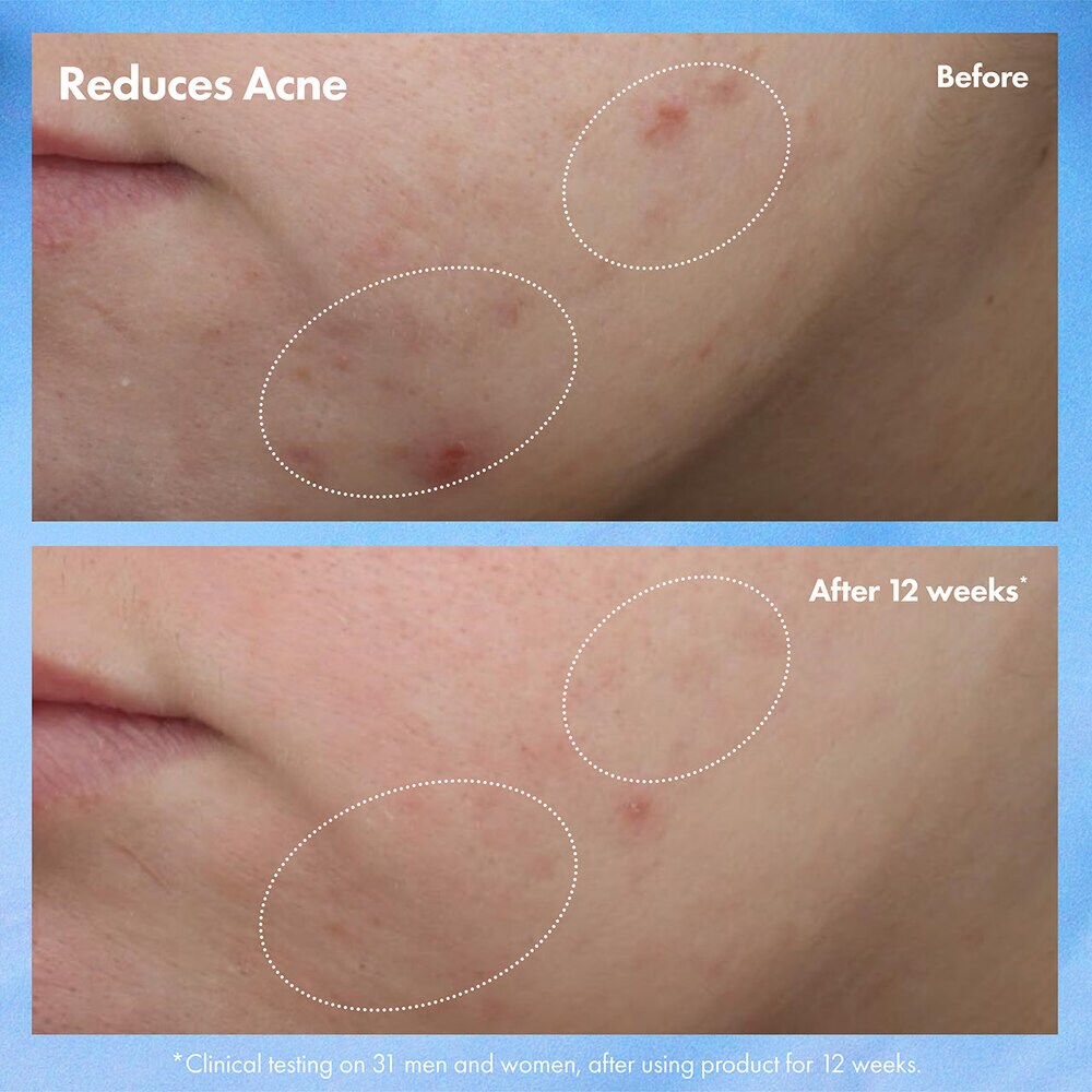 CLEAR IMPROVEMENTâ„¢ Blemish Clearing Hydrating Lotion