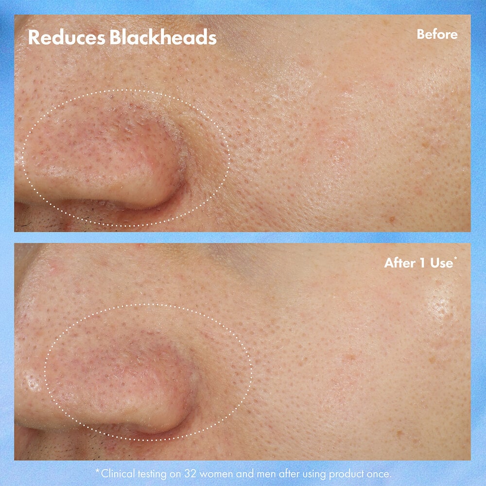 Clear Improvementâ„¢ Blackhead Clearing Mask-to-Scrub